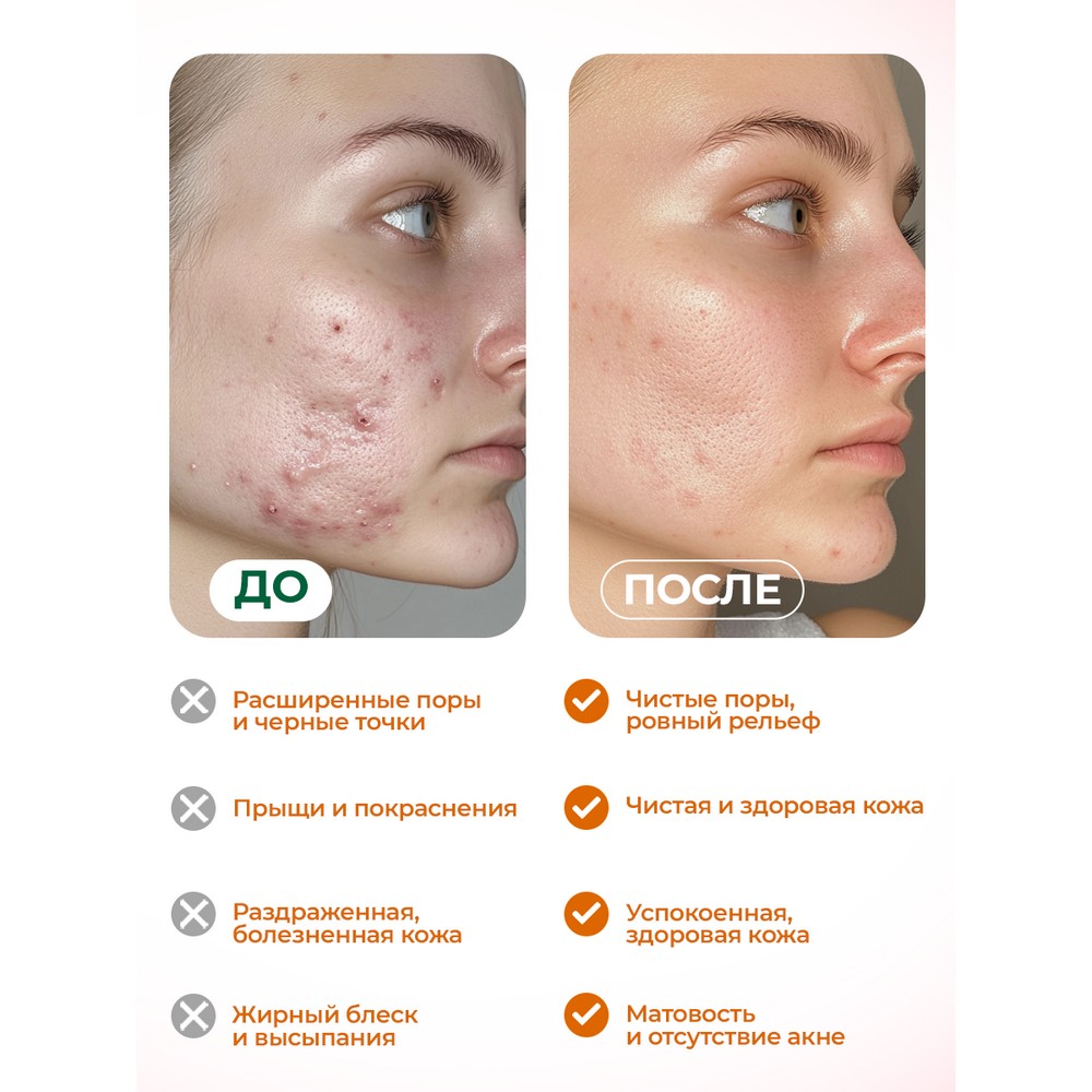 Гель для лица против акне, постакне и черных точек Mentholatum Acnes с экстрактом куркумы 12г. Фото 7.